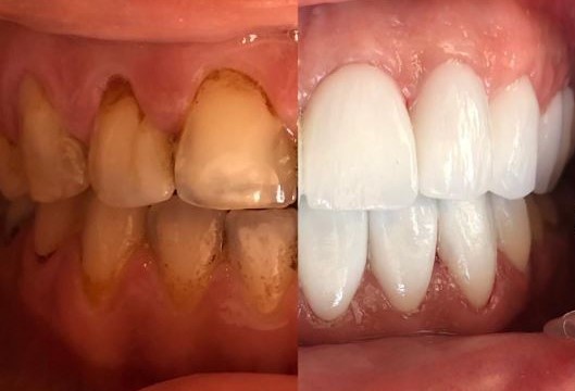 Laminate Veneers Teeth Laminate Veneers Teeth procedure in Turkey